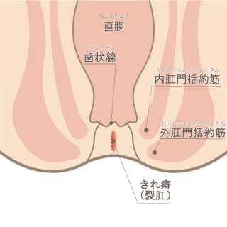 きれ痔